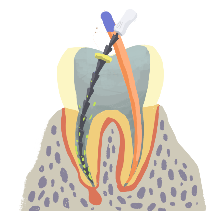 root_canal_treatment1